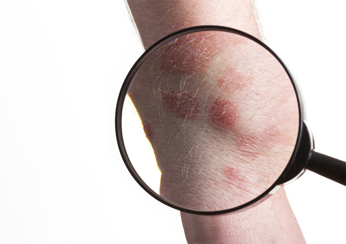 psoriasis magnifying glass.jpg