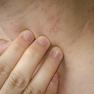 Dry skin and eczema this OTC traiing.jpg