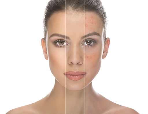 Pharmacist training support acne.jpg