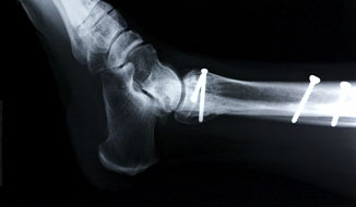 Xray_fractured ankle THUMB.jpg
