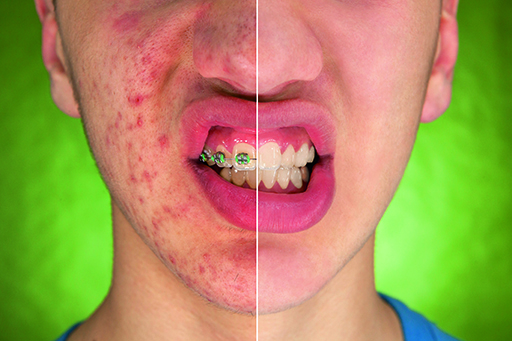 No more antibiotics for acne.jpg