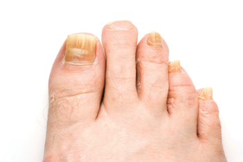Feet_nail_infection_s.jpg