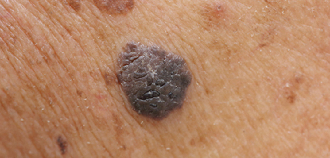 melanoma.jpg
