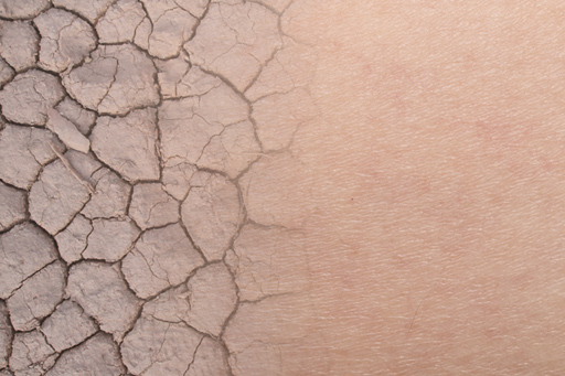 Skin_cracked_s.jpg