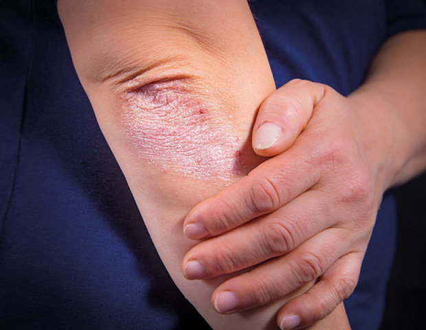 psoriasis_s.jpg